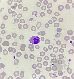 Howell - Jolly body -like inclusions in neutrophils 1