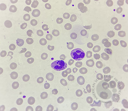 Howell - Jolly body -like inclusions in neutrophils 2