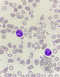 Howell - Jolly body -like inclusions in neutrophils 3