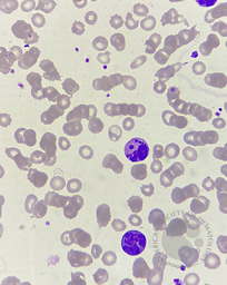 Howell - Jolly body -like inclusions in neutrophils 4