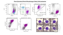 Flow Cytometry & Morphology of Hairy Cell Leukaemia (HCL)
