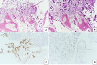 Bone sclerosis and lysis in metastatic adenocarcinoma of lung