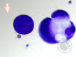 Metastatic carcinoma with signet ring differentiation 3