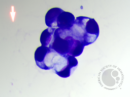 Metastatic carcinoma with signet ring differentiation 4