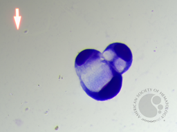 Metastatic carcinoma with signet ring differentiation 5