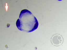 Metastatic carcinoma with signet ring differentiation 6