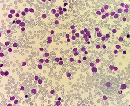 Blastic Plasmacytoid Dendritic Cell Neoplasm 1