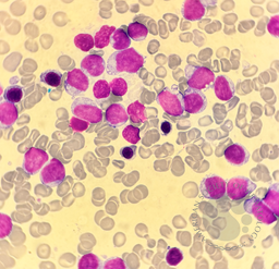 Blastic Plasmacytoid Dendritic Cell Neoplasm 3