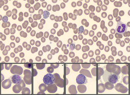 Plasmodium Vivax Infection - A case of long latency