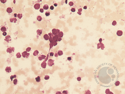 Bone marrow morphology and flow cytometry plots 1