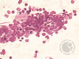 Bone marrow morphology and flow cytometry plots 2
