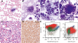 A challenging case of mast cell sarcoma primarily involving the bone marrow