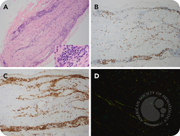 An unusual presentation of lymphoplasmacytic lymphoma with isolated brachial plexus infiltration and amyloidosis
