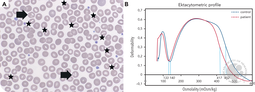 Polycythemia revealing PIEZO1 hereditary xerocytosis