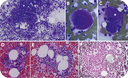 A 1-year-old child with essential thrombocythemia