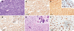 Herpetic lymphadenitis mimicking Richter transformation of chronic lymphocytic leukemia/small lymphocytic lymphoma