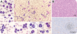 Binucleated and cloverleaf-shaped nucleus in lymphocytes in CLL