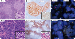 Double-hit, double-expressor follicular lymphoma with plasmacytic differentiation