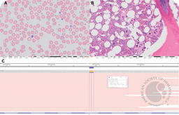 Essential thrombocythemia with MPL W515S mutation