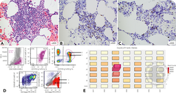 Biclonal mantle cell lymphoma
