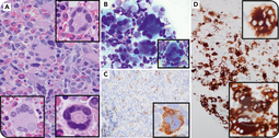 “Ring-form” megakaryocytic dysplasia in STAG2-mutated myelodysplastic neoplasm