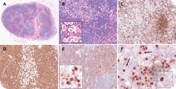 Mantle cell lymphoma with marked plasmacytic differentiation: two contrasting faces