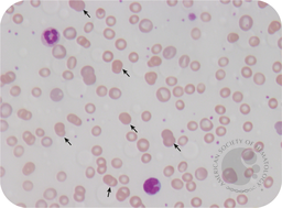 Doublet spherocytes