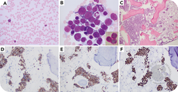 AEL transformed from post-ET myelofibrosis with a sinusoidal pattern, JAK2 mutation, and biallelic TP53 inactivation