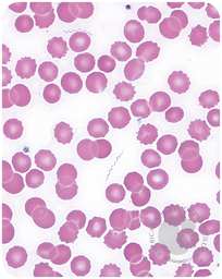 Soft tick relapsing fever in a traveler returning from Colorado