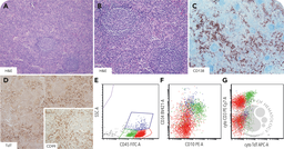 Castleman disease with modest T-lymphoblastic proliferation