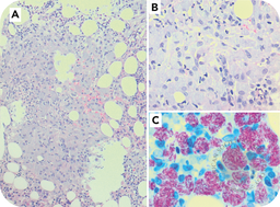 Unmasking atypical bone marrow TB