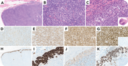 Occult ALK-negative anaplastic large cell lymphoma complicating chronic lymphocytic leukemia