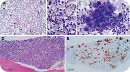 A 3-year-old with chronic myeloid leukemia
