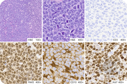 Flower cell morphology in high-grade B-cell lymphoma of the maxillary sinus