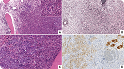 PCM1::JAK2 myeloproliferative neoplasm suggested by bone marrow histopathological features