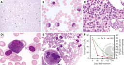 Chronic eosinophilic leukemia with a novel JAK1 mutation responds well to the JAK1/2 inhibitor ruxolitinib