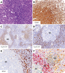 Mantle cell lymphoma with IRTA1 reactive expansion of the marginal zone