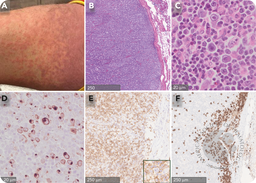 HHV-6 lymphadenitis with DRESS syndrome: another lymphoma mimic
