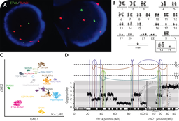 B-ALL with intrachromosomal amplification of chromosome 21 in a carrier of the Robertsonian translocation rob(14;21)c