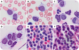 Pseudo-Chédiak-Higashi inclusions in a low-grade lymphoid neoplasm