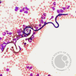 Microflaria Seen in Peripheral Blood Smear