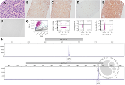 A case of Richter transformation to diffuse large B-cell lymphoma with aberrant T-cell marker expression