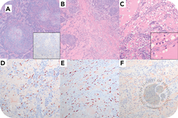 KSHV/HHV-8-associated multicentric Castleman disease and nodal Kaposi sarcoma displaying a lymphangiectatic pattern