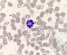 Botryoid neutrophil