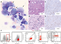 HHV-8 diffuse large B-cell lymphoma with EBV coinfection occurring posttransplant