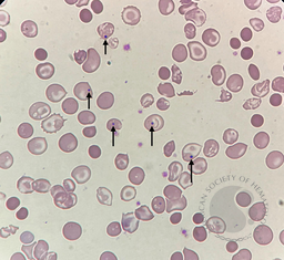 Howell-jolly bodies