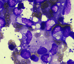Bone marrow histoplasmosis. BMAX100