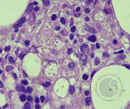 Bone marrow histoplasmosis. BMBXX100