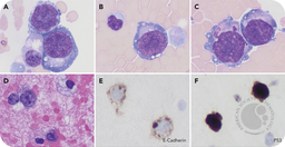 Immature erythroblasts in pleural effusion: an initial presentation of acute erythroid leukemia in a patient with a history of MDS