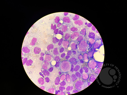 PLASMA CELL LEUKEMIA 1
